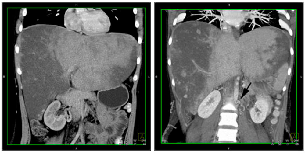 Budd Chiari syndrome